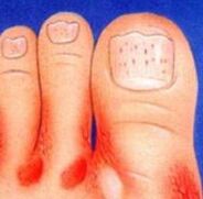 Fungi on your feet