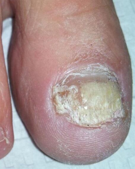 Fungi on your feet