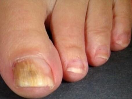 Fungus nail