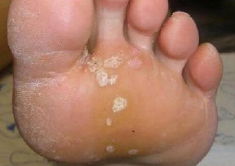 Funting skin lesions