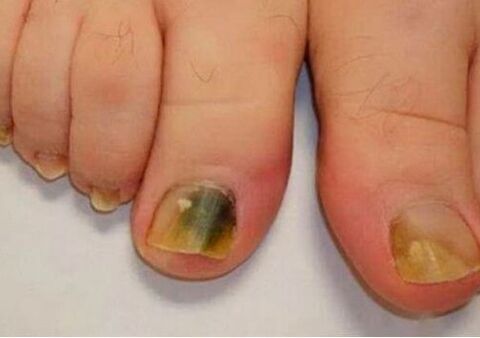 Infection affects nail plates