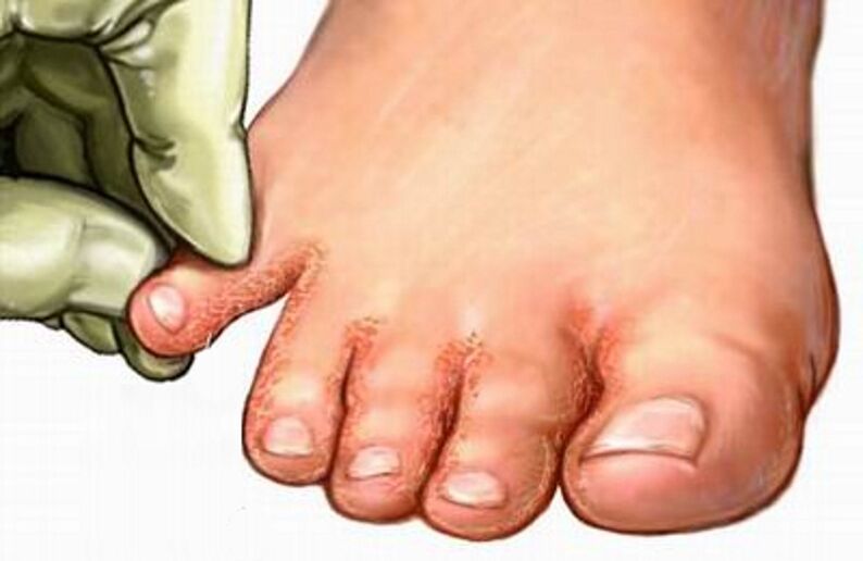 Fungi on your feet