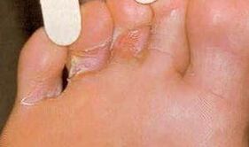 Dermaid Lesions for Mycosony Foot