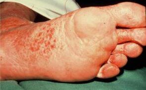 Fungi on foot with ulcers