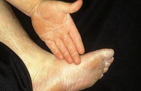 The deleted form of mycosis is manifested by scribing