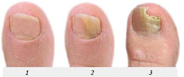 Fungus development process on thumb