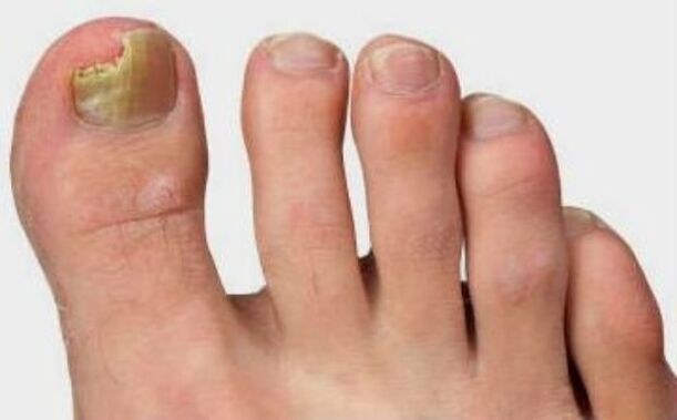 Mushroom on the thumb leg