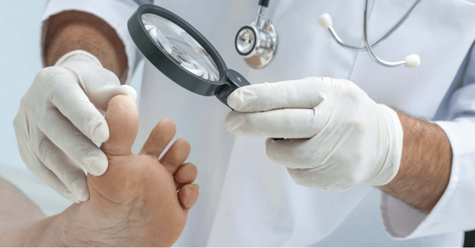 The first symptoms of fungus on your feet
