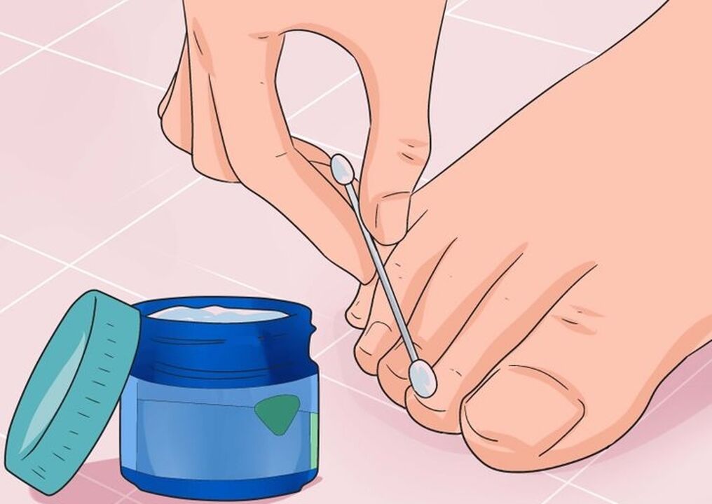 Cure fungus nails