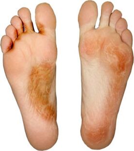 Heal the fungus on your finger and don't pick him up again