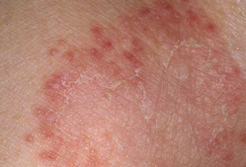 How to heal a fungus quickly, the doctor will say