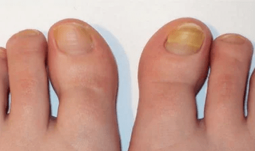 Home Phase Fungi Nail