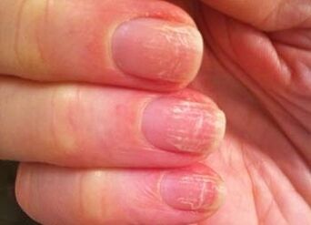 Home Phase of Fungi on nails