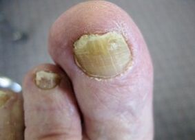 Causes appear to be fungus on nails