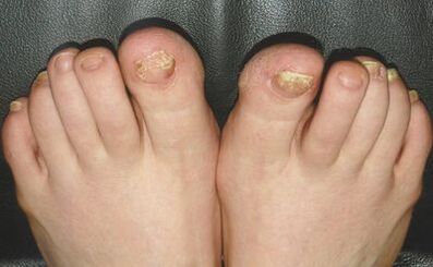 Signs of nail fungus
