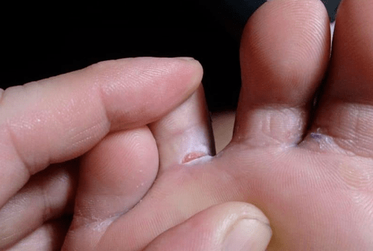 The appearance of bubbles on their feet