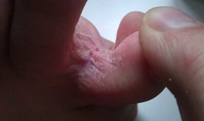 Fungi development phases between toes