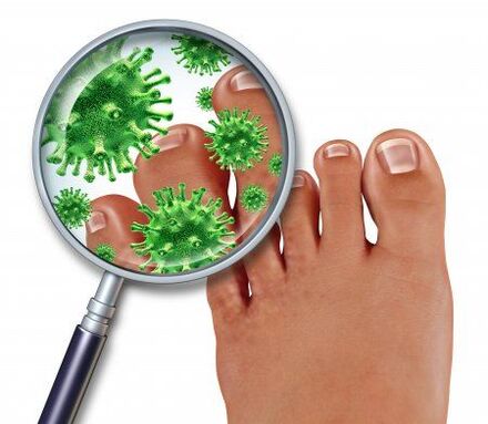 fungal infections of the feet