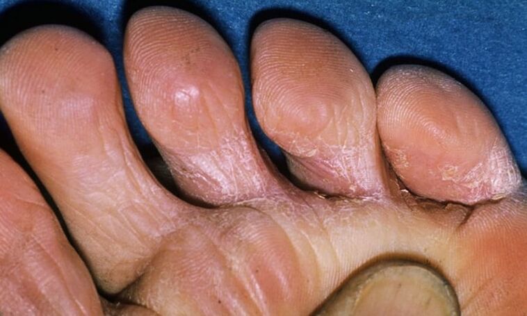 Different types of leg fungus