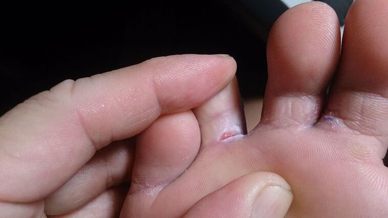 Fungus feet