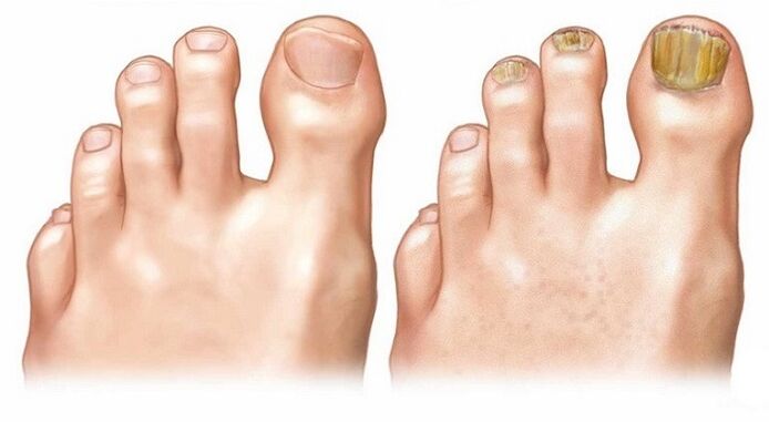 healthy nails and foot fungus