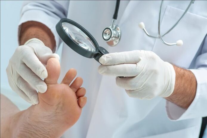 Before prescribing treatment for toenail fungus, the doctor will perform an examination