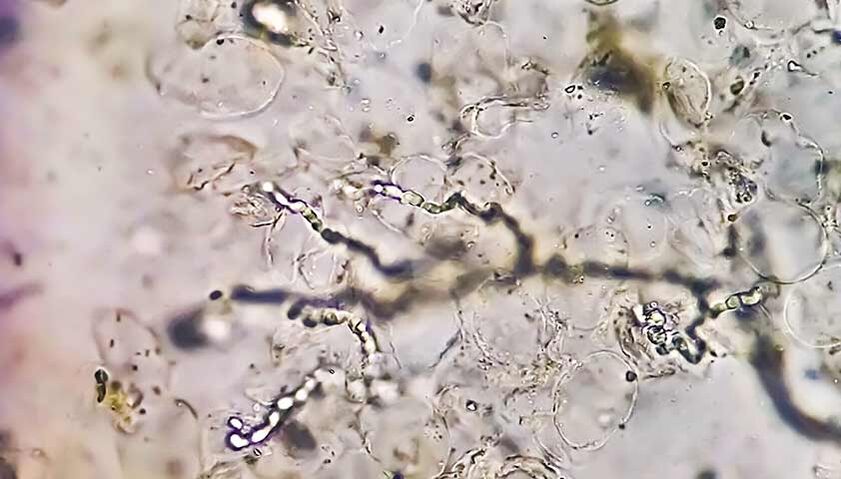 Fungi under the microscope – the culprit for the development of foot mycosis