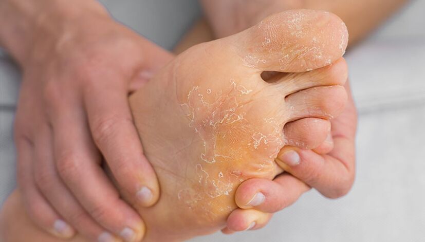 Skin peeling and itching are symptoms of foot fungus